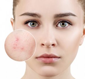 Cach tri mun boc (1)