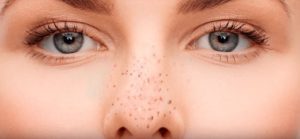 cach tri mun dau den (1)