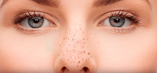 cach tri mun dau den (1)