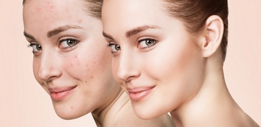 Quy trinh cham soc da mun hang ngay (1)